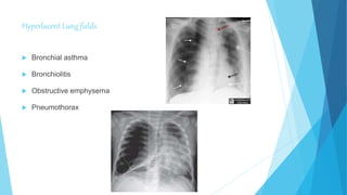 Hyperlucent Lung fields
 Bronchial asthma
 Bronchiolitis
 Obstructive emphysema
 Pneumothorax
 