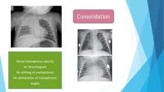 Dense homogenous opacity
Air Bronchogram
No shifting of mediastinum
No obliteration of Costophrenic
angles
Consolidation
 