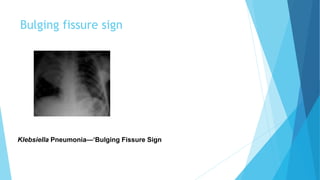 Bulging fissure sign
Klebsiella Pneumonia—‘Bulging Fissure Sign
 