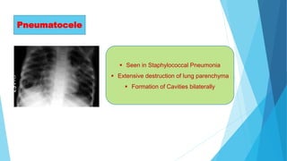 Pneumatocele
 Seen in Staphylococcal Pneumonia
 Extensive destruction of lung parenchyma
 Formation of Cavities bilaterally
 