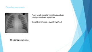 Bronchopneumonia
Bronchopneumonia
Fine, small, nodular or reticulonodular
patchy/ confluent opacities
Small bronchioles , alveoli involved
 