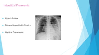 Interstitial Pneumonia
 Hyperinflation
 Bilateral interstitial infiltration
 Atypical Pneumonia
 