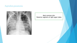 Aspiration pneumonia
Most common site:
Posterior segment of right upper lobes
 