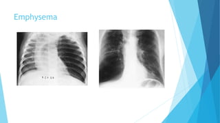 Emphysema
 