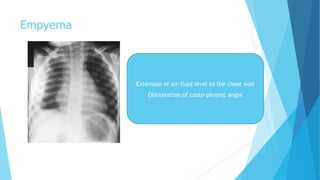Empyema
Extension of air-fluid level to the chest wall
Obliteration of costo-phrenic angle
 