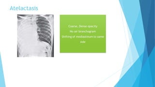 Atelactasis
 
