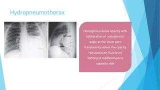 Hydropneumothorax
 