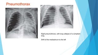 Pneumothorax
Right pneumothorax, with lung collapse of a compliant
lung.
Shift of the mediastinum to the left
 