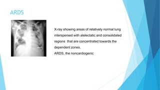 ARDS
X-ray showing areas of relatively normal lung
interspersed with atelectatic and consolidated
regions that are concentrated towards the
dependent zones.
ARDS, the noncardiogenic
 