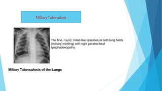 Miliary Tuberculosis of the Lungs
The fine, round, millet-like opacities in both lung fields
(military mottling) with right paratracheal
lymphadenopathy.
Milliary Tuberculosis
 