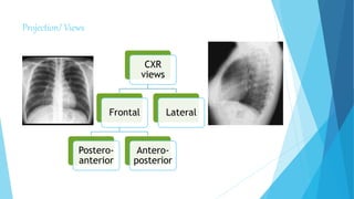Projection/ Views
CXR
views
Frontal
Postero-
anterior
Antero-
posterior
Lateral
 