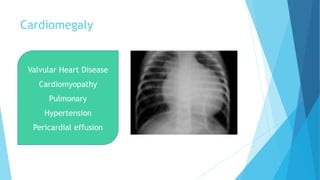 Cardiomegaly
Valvular Heart Disease
Cardiomyopathy
Pulmonary
Hypertension
Pericardial effusion
 