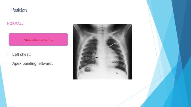 Paediatric Chest X-ray Interpretation | PPTX | Lung and Respiratory ...