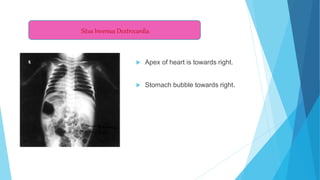  Apex of heart is towards right.
 Stomach bubble towards right.
Situs Inversus Dextrocardia
 