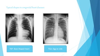 Typical shapes in congenital heart diseases
TOF: Boot Shaped heart TGA: Egg-on side
 