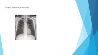 Normal Pulmonary Vasculature
 