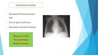  Decreased Pulmonary blood
flow.
 Due to right to left shunt.
 Decreased vascular markings.
Tetralogy of Fallot
Tricuspid Atresia
Ebstein Anomaly
PULMONARY OLIGEMIA
 