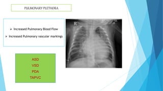 PULMONARY PLETHORA
ASD
VSD
PDA
TAPVC
 Increased Pulmonary Blood Flow
 Increased Pulmonary vascular markings
 