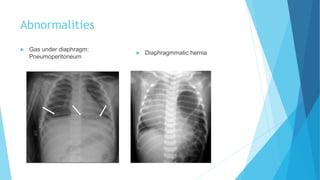 Abnormalities
 Gas under diaphragm:
Pneumoperitoneum
 Diaphragmmatic hernia
 