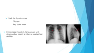  Look for : Lymph nodes
Thymus
Any tumor mass
 Lymph node: rounded , homogenous ,well
circumscribed opacity at hilum or paratracheal
position.
 