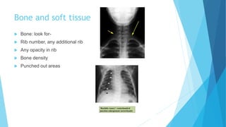 Bone and soft tissue
 Bone: look for-
 Rib number, any additional rib
 Any opacity in rib
 Bone density
 Punched out areas
 
