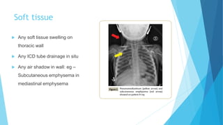 Soft tissue
 Any soft tissue swelling on
thoracic wall
 Any ICD tube drainage in situ
 Any air shadow in wall: eg –
Subcutaneous emphysema in
mediastinal emphysema
 