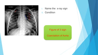 I. Name the x-ray sign
II. Condition
Figure of 3 sign
Coarctation of Aorta
 