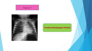 Diagnosis ?
Tracheo-Esophageal Fistula
 