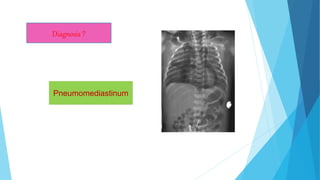 Diagnosis ?
Pneumomediastinum
 