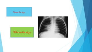 Name the sign
Silhouette sign
 