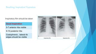 Breathing: Inspiration/ Expiration
Inspiratory film should be taken
Good Inspiration
5-7 anterior ribs visible
9-10 posterior ribs
Costophrenic , lateral rib
edges should be visible
 