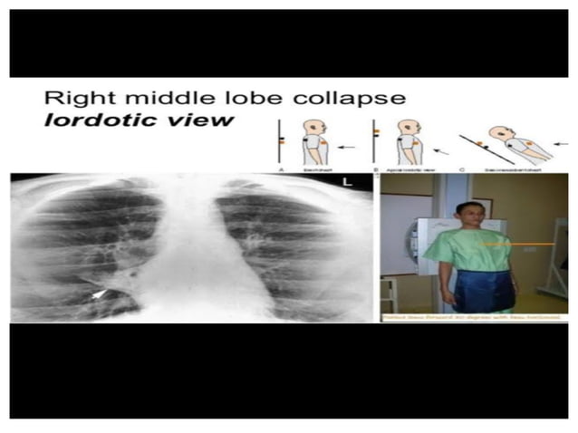 Lordotic View Chest x-ray interpretation.pdf