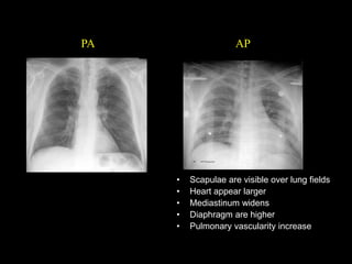PA
• Scapulae are visible over lung fields
• Heart appear larger
• Mediastinum widens
• Diaphragm are higher
• Pulmonary vascularity increase
AP
 