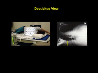 Decubitus View
• "decubitus" means "lying down“
• To confirm free flowing effusion.
 