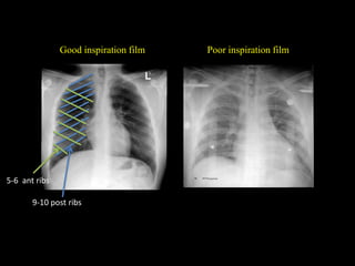 Good inspiration film Poor inspiration film
9-10 post ribs
5-6 ant ribs
 