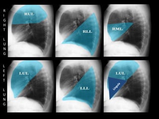 R
I
G
H
T
L
U
N
G
L
E
F
T
L
U
N
G
 