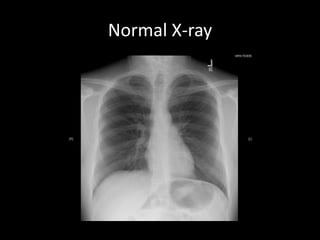 Normal X-ray
 