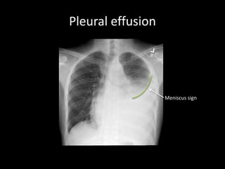 Pleural effusion
Meniscus sign
 