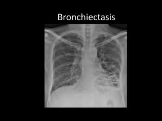 Bronchiectasis
 
