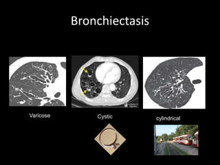 Bronchiectasis
Varicose Cystic cylindrical
 