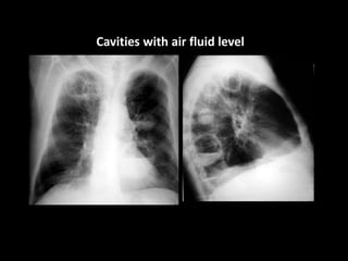 Cavities with air fluid level
 