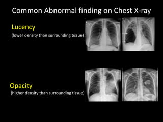 Common Abnormal finding on Chest X-ray
Lucency
(lower density than surrounding tissue)
Opacity
(higher density than surrounding tissue)
 