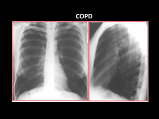 COPD
 