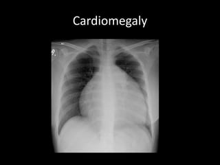 Cardiomegaly
 