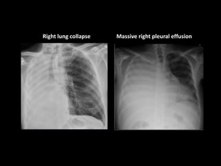 Right lung collapse Massive right pleural effusion
 