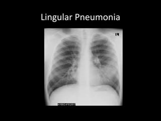 Lingular Pneumonia
 