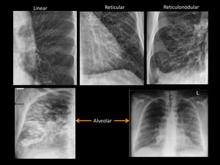 Linear Reticular Reticulonodular
Alveolar
 