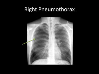 Right Pneumothorax
 