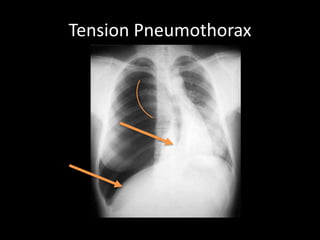 Tension Pneumothorax
 