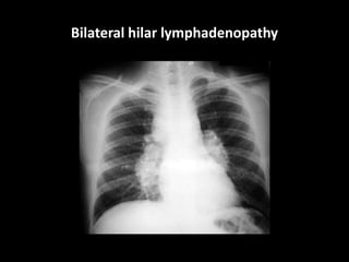 Bilateral hilar lymphadenopathy
 